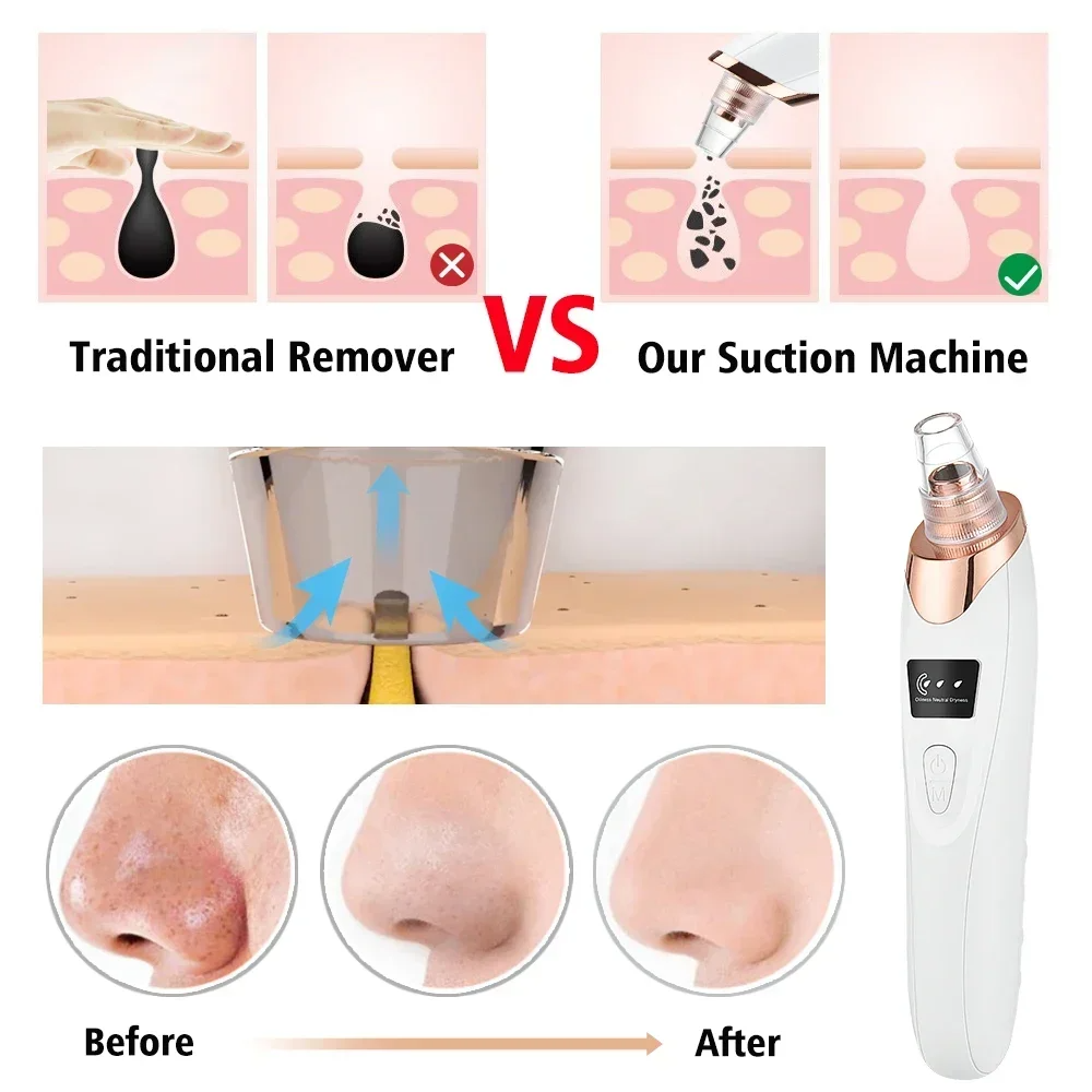 PoreRemover All-in-One Aufsätze