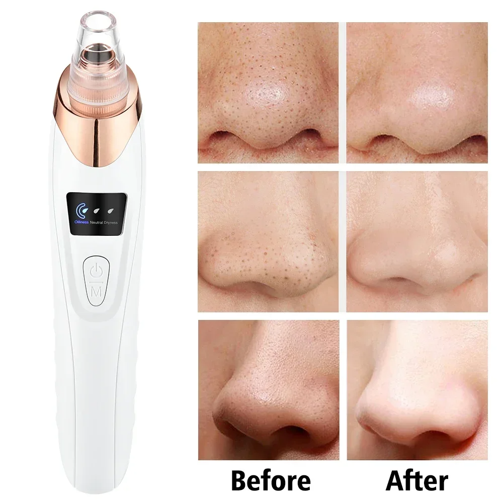PoreRemover Anwendungsroutine